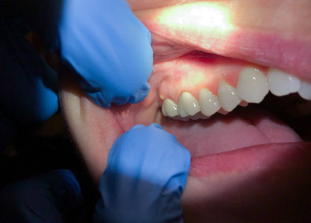 Best Emergency Treatment for Dental Infections or Abscesses in Bingham Farms, MI