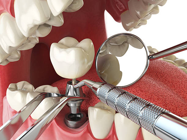 Best Emergency Root Canal Treatment in Bingham Farms, MI